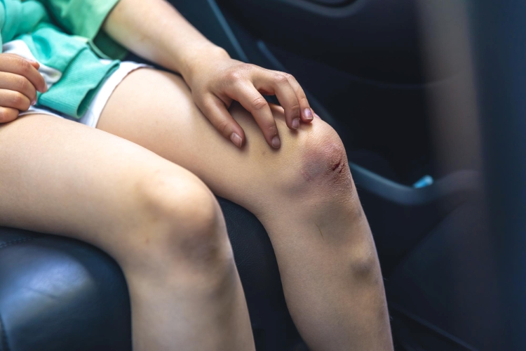 (Lipoma, Sumber: Freepik)