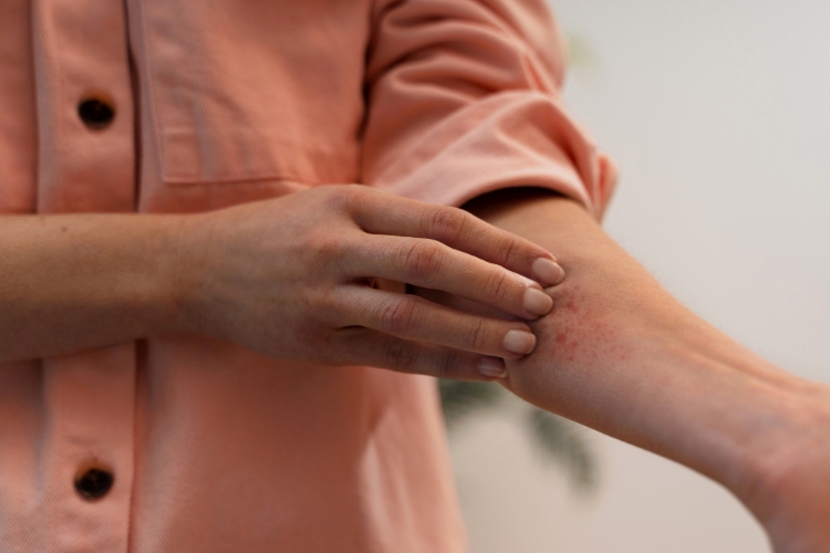(Lupus, Sumber: Freepik)