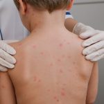 Mpox (Cacar Monyet): Virus yang Harus Diwaspadai, Ini Gejala dan Penularannya!