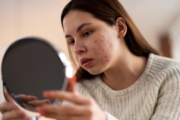 Imunitas Lemah? Ini Cara Sistem Imun Mempengaruhi Jerawat Hormonal pada Wanita!