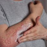 Mengenal Penyakit Lupus: Cara Mendeteksi dan Mengelola Penyakit Autoimun